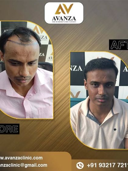 This client's appearance is completely transformed with a new, fuller head of hair. The after photo shows a happy and confident individual.