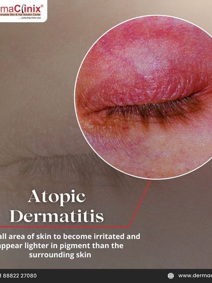 An image of Atopic Dermatitis (eczema), which can cause small areas of skin to become irritated and appear lighter in pigment than the surrounding skin.