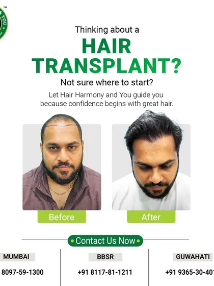 A receding hairline can be a major concern, but it's a problem I solve every day. This before and after image demonstrates a significant restoration, creating a fuller, more defined hairline that perfectly frames the face.