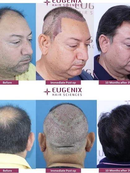 A detailed look at a patient's journey from before the procedure, to immediately post-op, and finally the 10-month result. This shows the healing process and the final, dense outcome from the back and side.