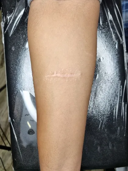 A clear 'before' photo of the surgical scar on the forearm prior to the tattoo.
