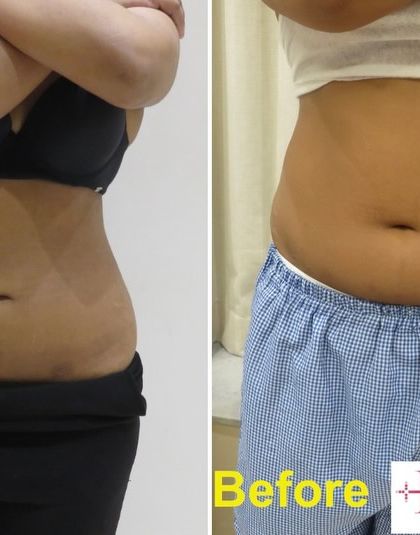 This before and after view from the front shows the result of abdominal liposuction. Notice the reduction in fullness around the waist and the more defined midsection. This procedure helps create a flatter stomach and a more streamlined silhouette.