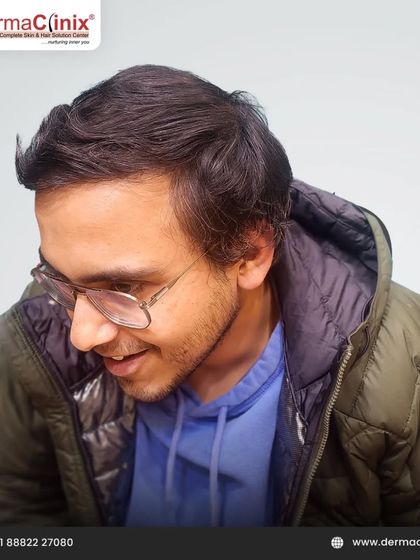 A close up of the patient's new, dense hairline one year after his B.E.S.T. FUE transplant. The natural look and feel of the hair is a primary goal in all our procedures.