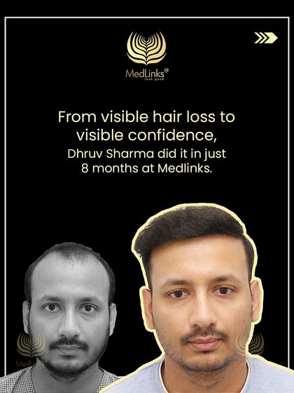 From visible hair loss to visible confidence, this collage shows Dhruv Sharma's 8-month journey with us.