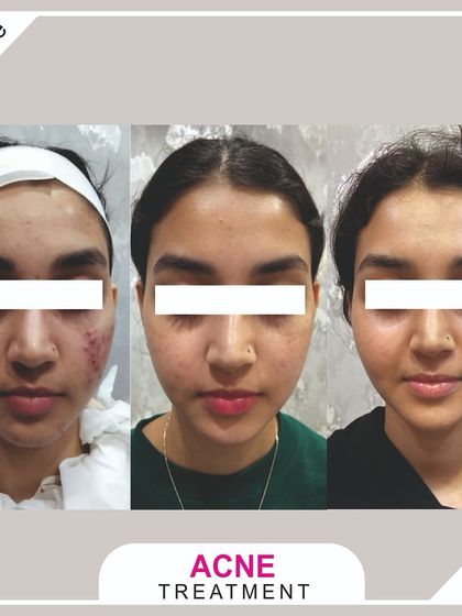 This front-view before-and-after highlights the reduction in facial acne and improved overall skin clarity after a few sessions.