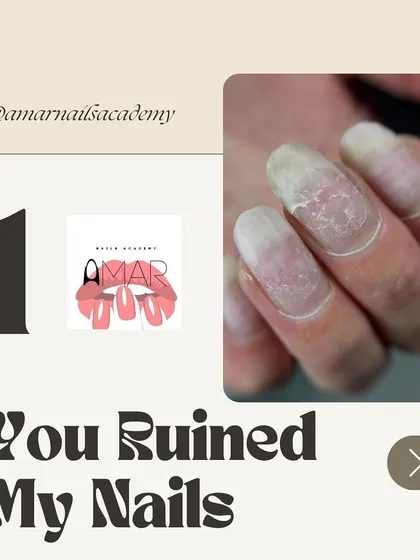 The number one reason for nail damage after extensions. This image shows the result of ripping off enhancements, which peels away layers of the natural nail.