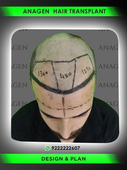 This is our surgical blueprint. The numbers indicate the precise number of grafts planned for each zone: 1360 for the frontal hairline, 450 for the central core, and 1250 for the mid-scalp, ensuring strategic density.