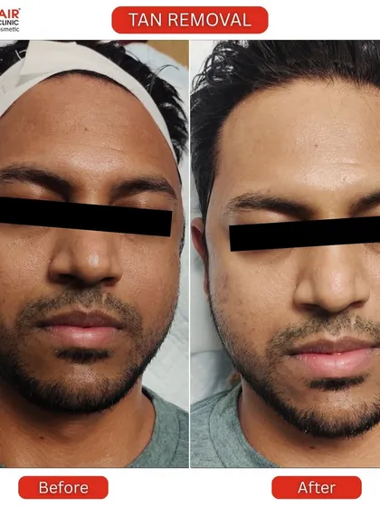 This is a clear example of our effective tan removal treatment. We help restore your skin's natural tone, reversing sun damage to reveal a brighter, healthier complexion. The process is quick, safe, and delivers visible results.