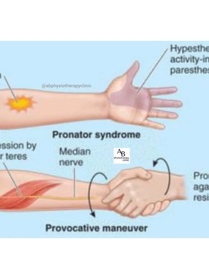Pronator Syndrome is another condition where the median nerve is compressed, but higher up in the forearm. It causes pain in the forearm and numbness in the hand.