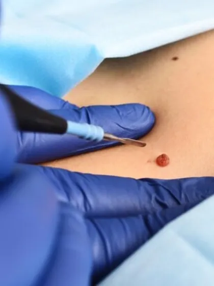 Here you can see the radiofrequency cautery technique in action for mole removal. This method is extremely precise, allowing me to target the growth without affecting the surrounding skin, which is key to minimizing scarring and ensuring a clean, aesthetic result.