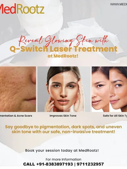 One of the key advantages of the Q-Switch laser is its safety profile across all skin types. It effectively treats pigmentation and acne scars while improving overall skin tone, making it a reliable option for many of my patients.