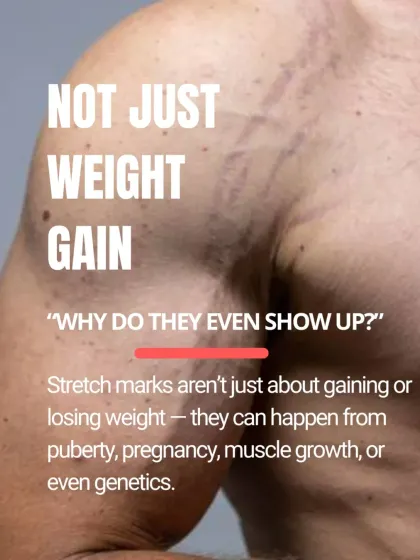 Stretch marks are not just caused by weight gain. They can also appear due to puberty, pregnancy, rapid muscle growth from working out, or even genetics.