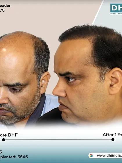 A side-profile view of the one-year result. This angle highlights the expertly crafted hairline that frames his face perfectly, showcasing the artistic skill of our DHI surgeons.