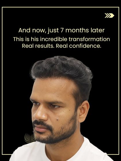 Just 7 months later, this is Lalit's incredible transformation. The result is real hair and real confidence.