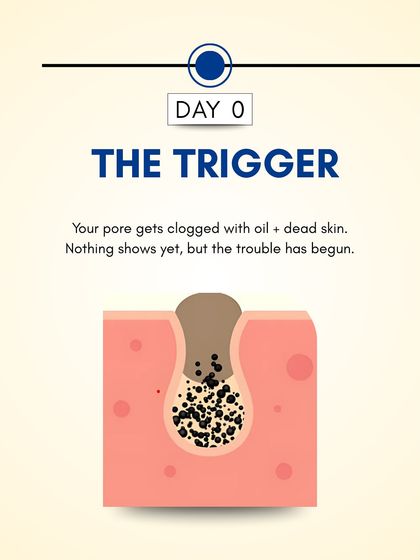 Day 0: The process begins when a pore gets clogged with oil and dead skin cells. At this stage, nothing is visible on the surface, but the foundation for a pimple has been laid.