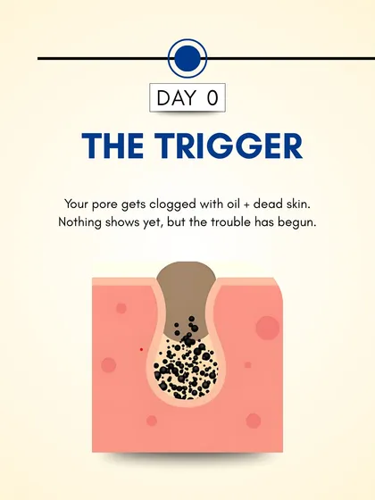 Day 0: The process begins when a pore gets clogged with oil and dead skin cells. At this stage, nothing is visible on the surface, but the foundation for a pimple has been laid.