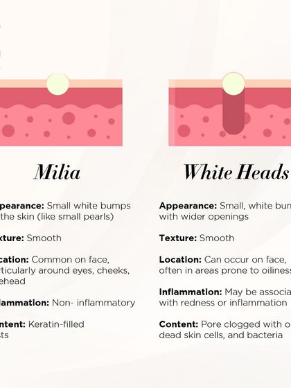 People often confuse milia with whiteheads, but they are very different. This simple comparison chart explains the key differences in appearance, location, and content, helping you understand why they require different treatment approaches.
