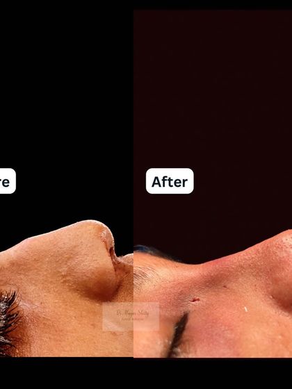 This patient felt her nose appeared too masculine due to a prominent dorsal hump. The after photo shows the immediate result of a rhinoplasty to create a softer, more feminine profile that is in harmony with her other facial features.