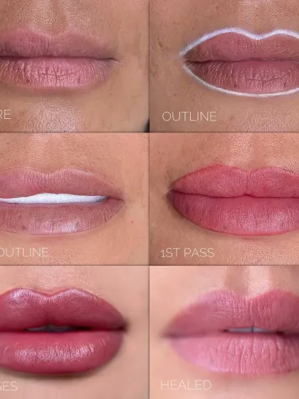 Achieving the perfect, natural-looking lips is a process I take very seriously. This image shows the step-by-step journey of a lip filler treatment, from the initial outline to the final healed result. My goal is always to enhance your natural shape for a balanced and beautiful smile, never to make it look 'done'.