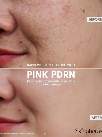This before and after comparison highlights the skin texture improvement from our Pink PDRN treatment. Notice the visible reduction in pores, fine lines, and unevenness, leading to a smoother and more radiant complexion.