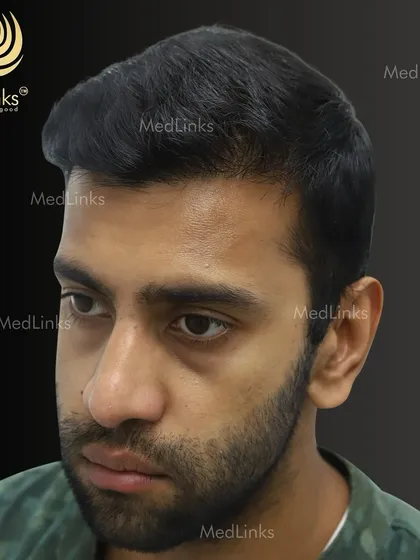 The final result from the side, showing a natural and dense hairline.