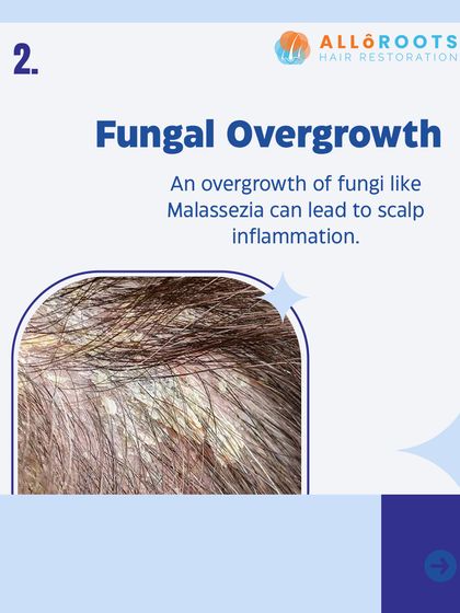 Fungal overgrowth, particularly from fungi like Malassezia, is a common cause of scalp inflammation and dandruff. This unhealthy scalp environment can impede hair growth.