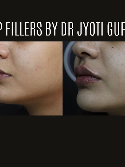 This is the same patient, showing a different angle of their lip filler result. Notice how the border of the lip is more defined and the shape is enhanced, giving a refreshed and youthful pout.