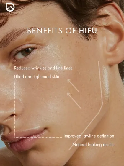 High-Intensity Focused Ultrasound, or HIFU, is one of my preferred methods for non-surgical skin tightening. This image illustrates its key benefits: reducing wrinkles, lifting sagging skin, and improving jawline definition for natural-looking results.