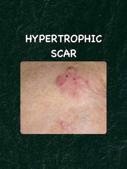 Hypertrophic scars are raised, thickened scars that form when the body produces too much collagen during healing. Treatment may involve steroid injections or silicone sheets.