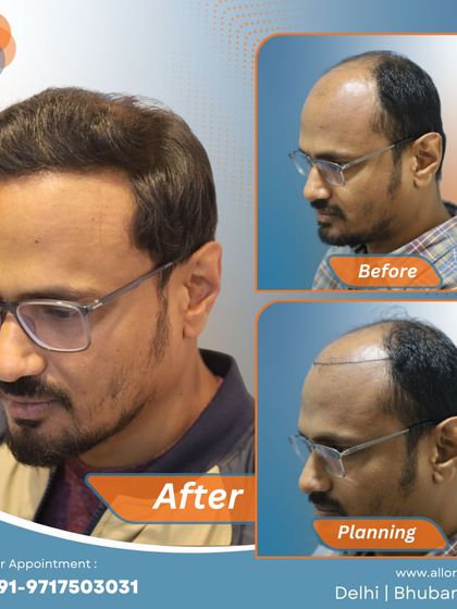 This series shows the meticulous planning phase with hairline marking, the before state, and the remarkable final result. It highlights the importance of a detailed approach to achieve a natural look.