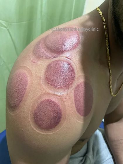The results of a cupping session for post-workout shoulder stiffness. The marks show where muscle tension was highest, and the client reported immediate relief.