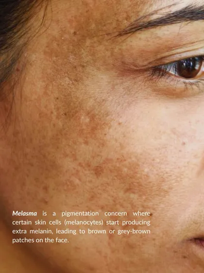Melasma is a common pigmentation concern where melanocytes produce extra melanin, leading to brown or grey-brown patches. Understanding its cause is the first step to effective treatment.