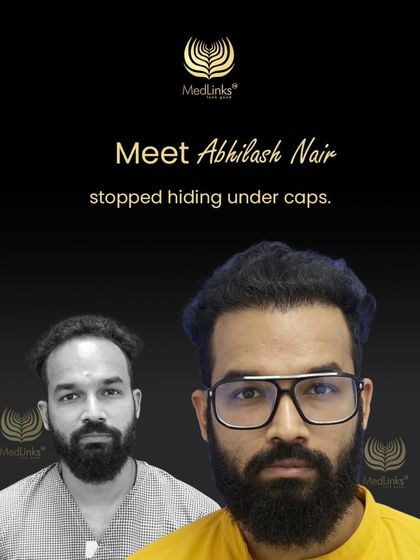 This collage shows Abhilash Nair's journey from hiding under caps to confidently showing off his new hair.