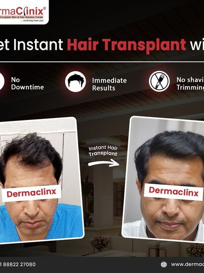 Another example of an Instant Hair Transplant result. This showcases how we can achieve a denser, natural look right after the procedure, eliminating the typical waiting period for hair growth.
