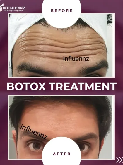 Botox isn't just for women. Here is an example of a male patient with a significant reduction in forehead lines, resulting in a more rested and youthful look.
