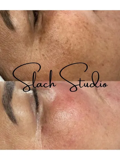 A close-up showing the reduction of pigmentation and redness, resulting in calmer, clearer skin.
