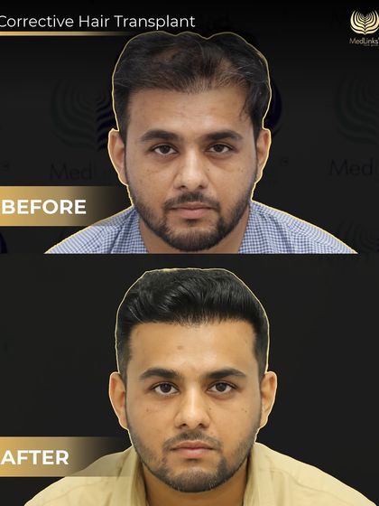 Another successful corrective transplant. The patient came to us with an unsatisfactory result from another clinic. We used 3500 grafts with our Perfect-i technique to restore a natural aesthetic and give him the result he deserved.