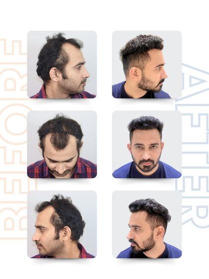An unbelievable transformation from every angle. This patient went from struggling with hair loss to a confident comeback. This is what expert care, a natural hairline restoration, and a painless procedure can achieve.