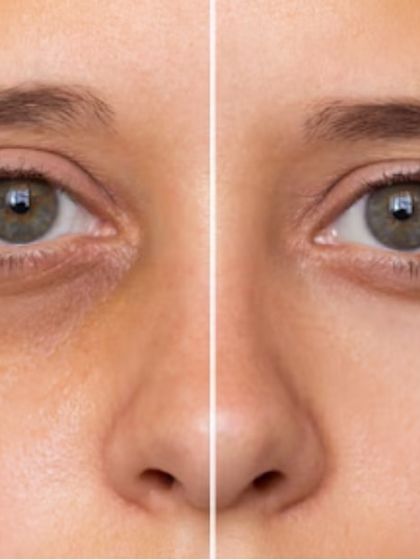 This before-and-after shows a significant reduction in under-eye dark circles and pigmentation. I use a combination of treatments to address the underlying causes, such as volume loss and hyperpigmentation.
