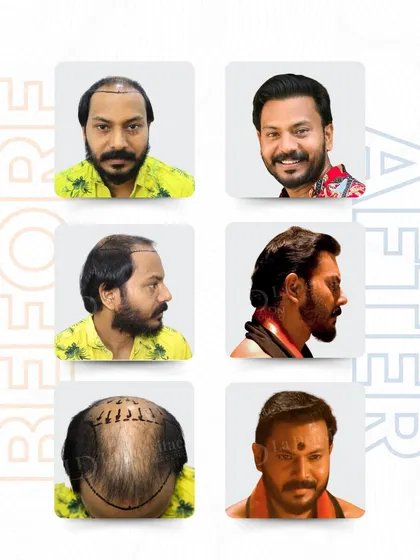 For an actor like Pramod Mani, confidence is key. His case was challenging due to a thin donor area, but with careful planning and the advanced RT-FUE technique, I implanted 5,836 grafts. This shows that even complex cases can achieve incredible, natural-looking density.