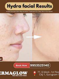 Acne & Acne Scar Treatment