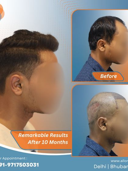 These images show the remarkable results after 10 months, including the planning stage. It's a clear demonstration of how careful planning leads to a successful and natural-looking outcome.