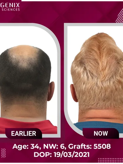 The full head hair transplant results for an international patient, showcasing a complete change with 5508 grafts.