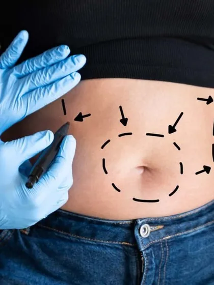 This image shows the pre-operative planning for liposuction on the abdomen. The markings indicate the zones for fat removal to achieve a sculpted and contoured result.