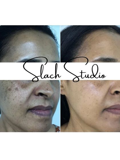 A great example of the treatment's effect on sun damage and freckling, resulting in a much clearer complexion.