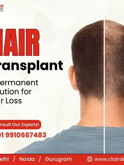 For those seeking a long-term fix for significant hair loss, our hair transplant service offers a permanent solution. This before and after image demonstrates how we can effectively restore a natural-looking hairline.