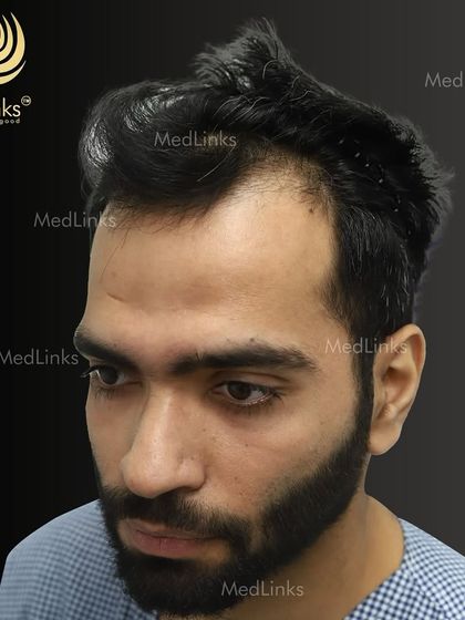 The patient's hair from the side before the procedure.