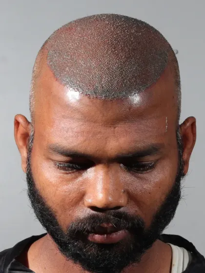 This is what a scalp looks like immediately after the procedure. Each dot is a carefully placed graft, the foundation of a future full head of hair.