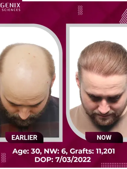 A stunning DHT hair restoration for a 30-year-old with Grade 6 baldness, requiring 11,201 grafts.