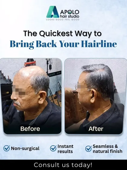 Restoring a hairline can dramatically change your appearance. For this client, we used a non-surgical hair replacement system to instantly bring back a defined and natural-looking hairline, showcasing a seamless and impressive finish.